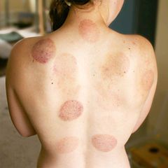 Health Traditions - Gua Sha - Accredited Courses in Cupping and Gua Sha