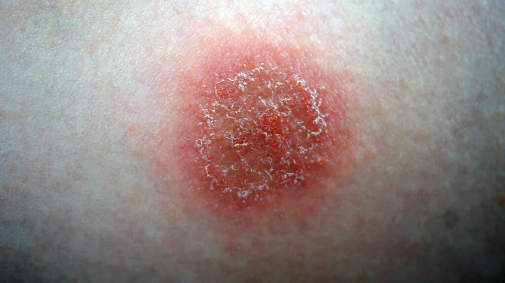 Nummular Eczema: Causes and How to Get Rid of It